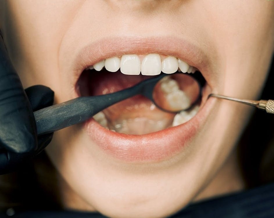 Tooth Extraction Vs Root Canal Which Treatment Is Best