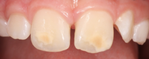 Molar Incisor Hypomineralisation