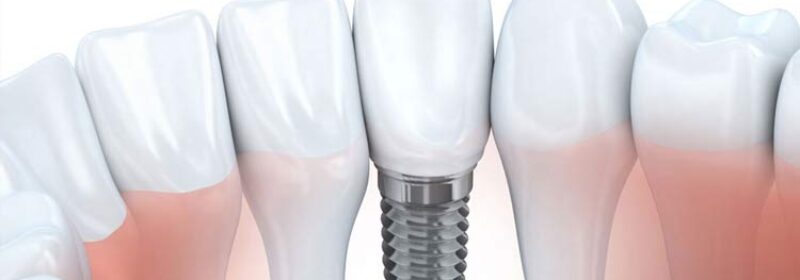 All you need to know about caring for your dental implants