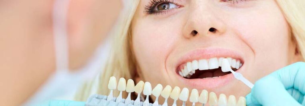 What Are Porcelain Veneers and are They Suitable for You?