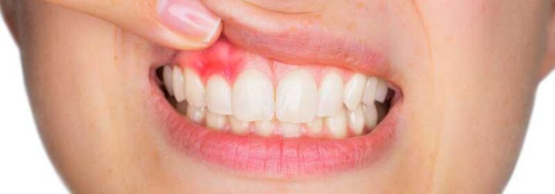 How Do Gum Diseases Affect Oral And Dental Health?