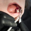 All you need to know about wisdom tooth extraction