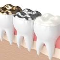 Fillings 101: 10 Patient’s Guide to Dental Restorations