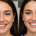 Dental Veneers for Teeth: How They Improve Shape, Colour, and Alignment