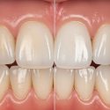 Enamel Veneers Explained: What They Are and How They Protect Teeth