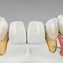 What Are Veneers? A Beginner’s Guide for Australian Patients