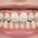 Invisalign Attachments Explained: What They Do, Pain, Removal & What to Expect